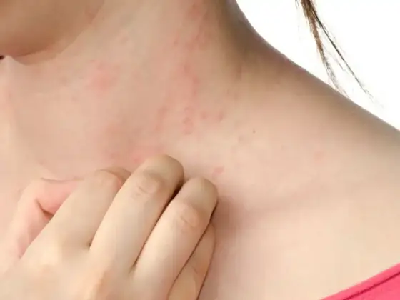 Pieczenie po acetonie - Podrażnienie czy alergia? Sprawdź!